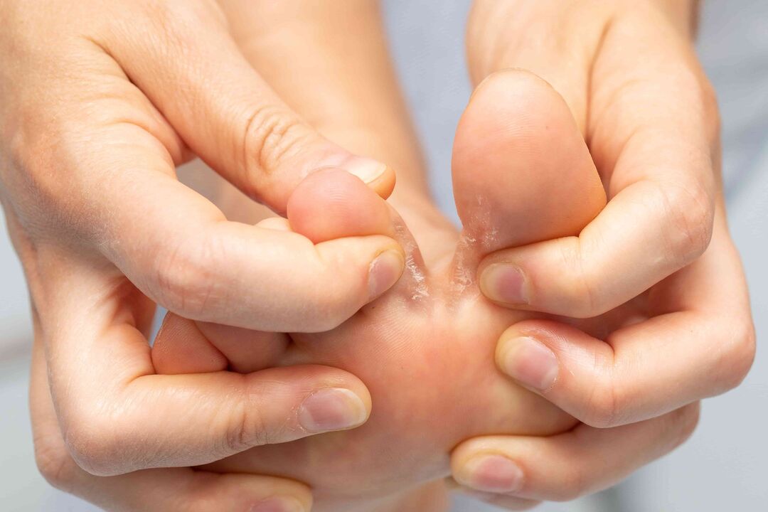Fungo entre os dedos dos pés e o seu tratamento con crema Demyxil