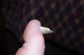 Síntomas de fungo nas uñas